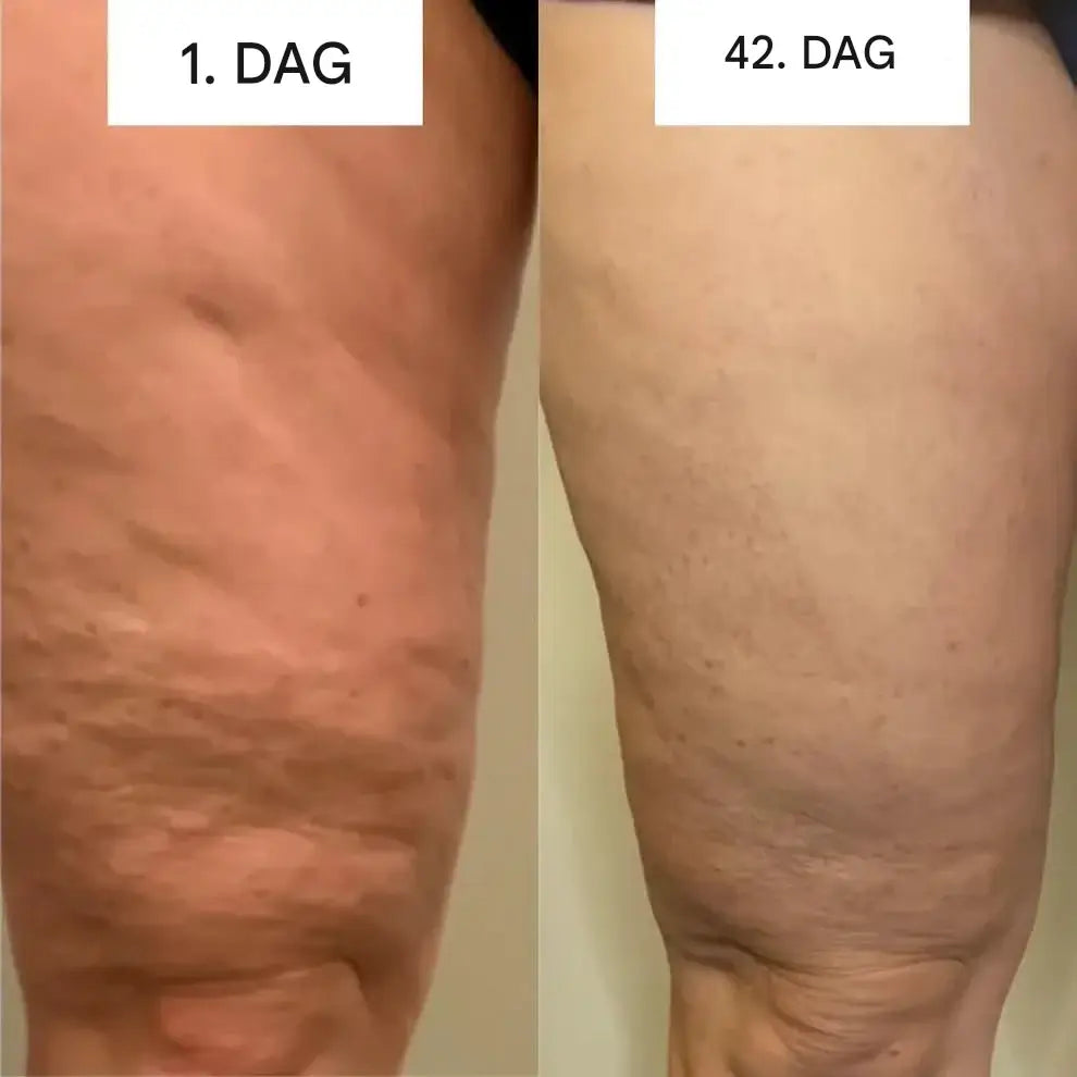 GlowCup - Cellulitisverwijderaar en huidversteviging met rood licht en Cuppingtherapie