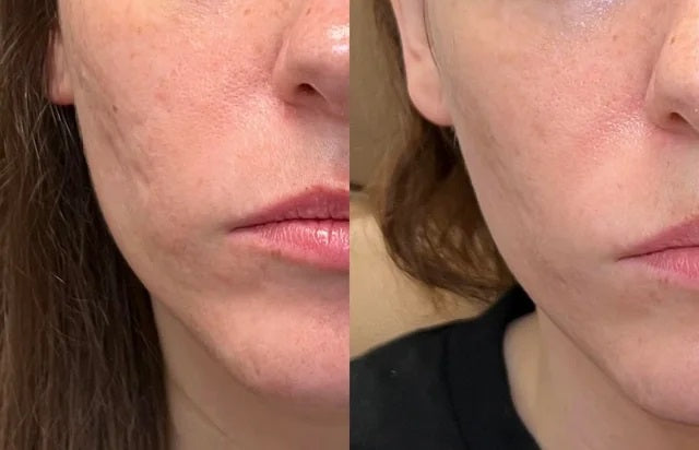 Luviva - Geavanceerde siliconen tape voor litteken- en rimpelbehandeling